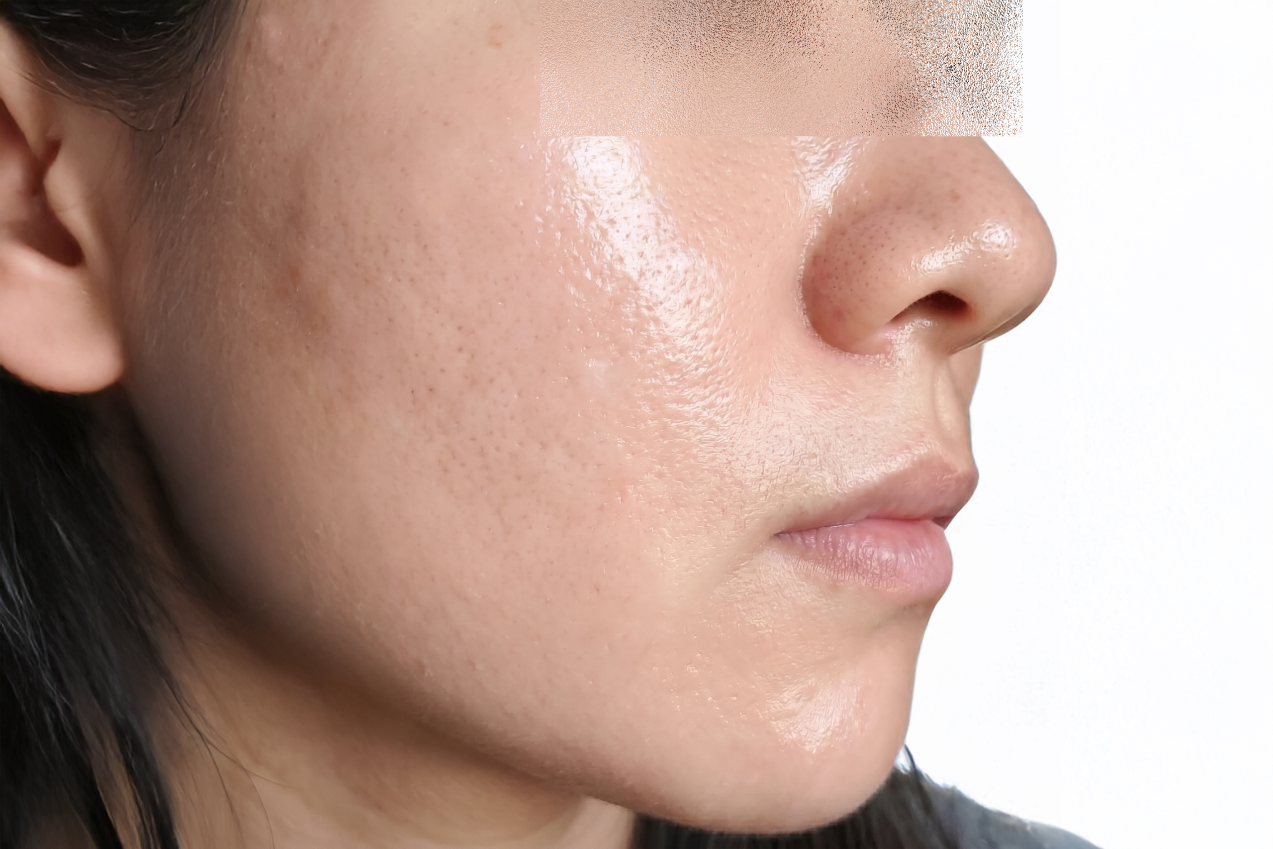 Case 1 Lumiderm Rx After scaled