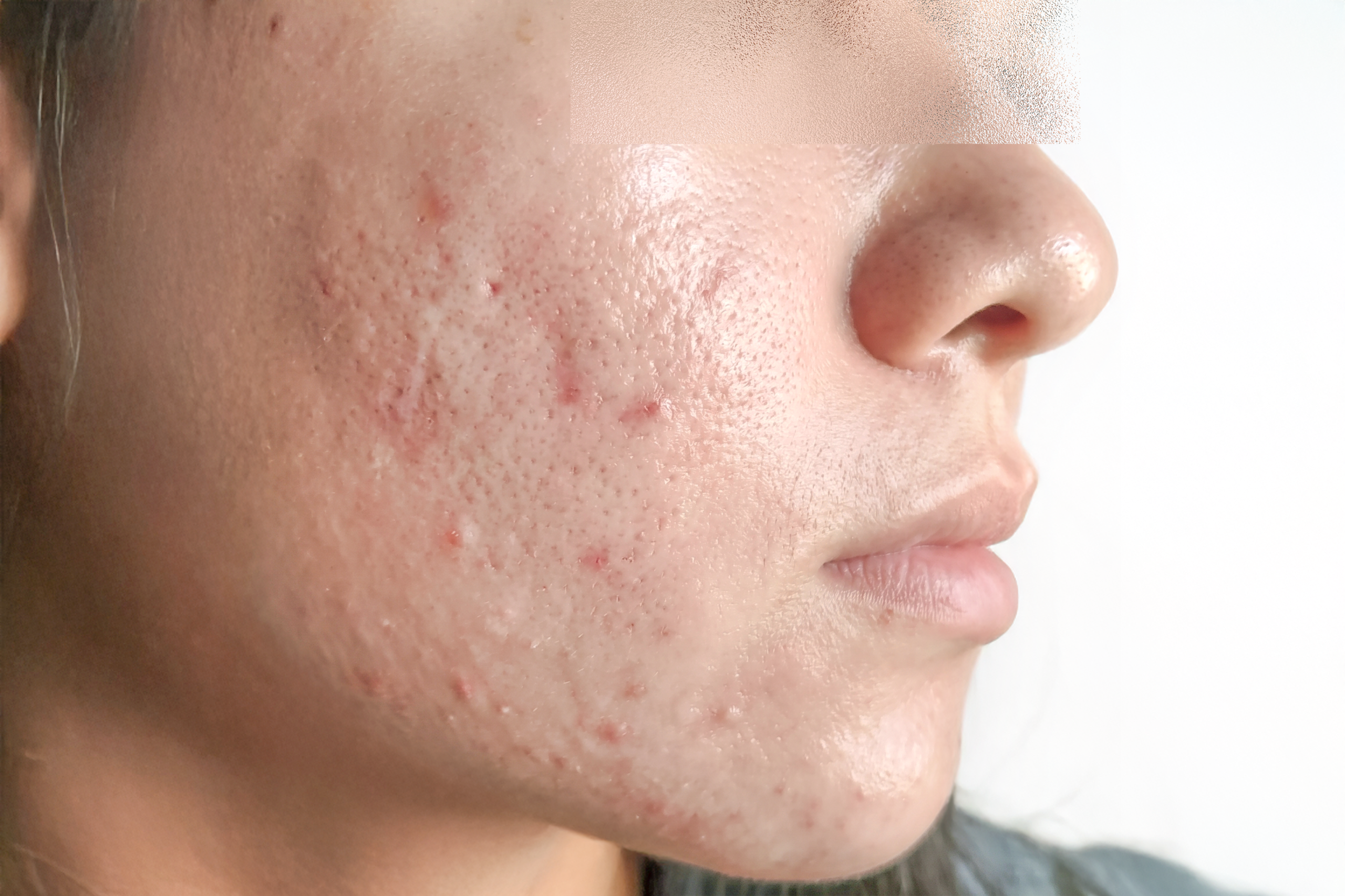 Case 1 Lumiderm Rx Before scaled