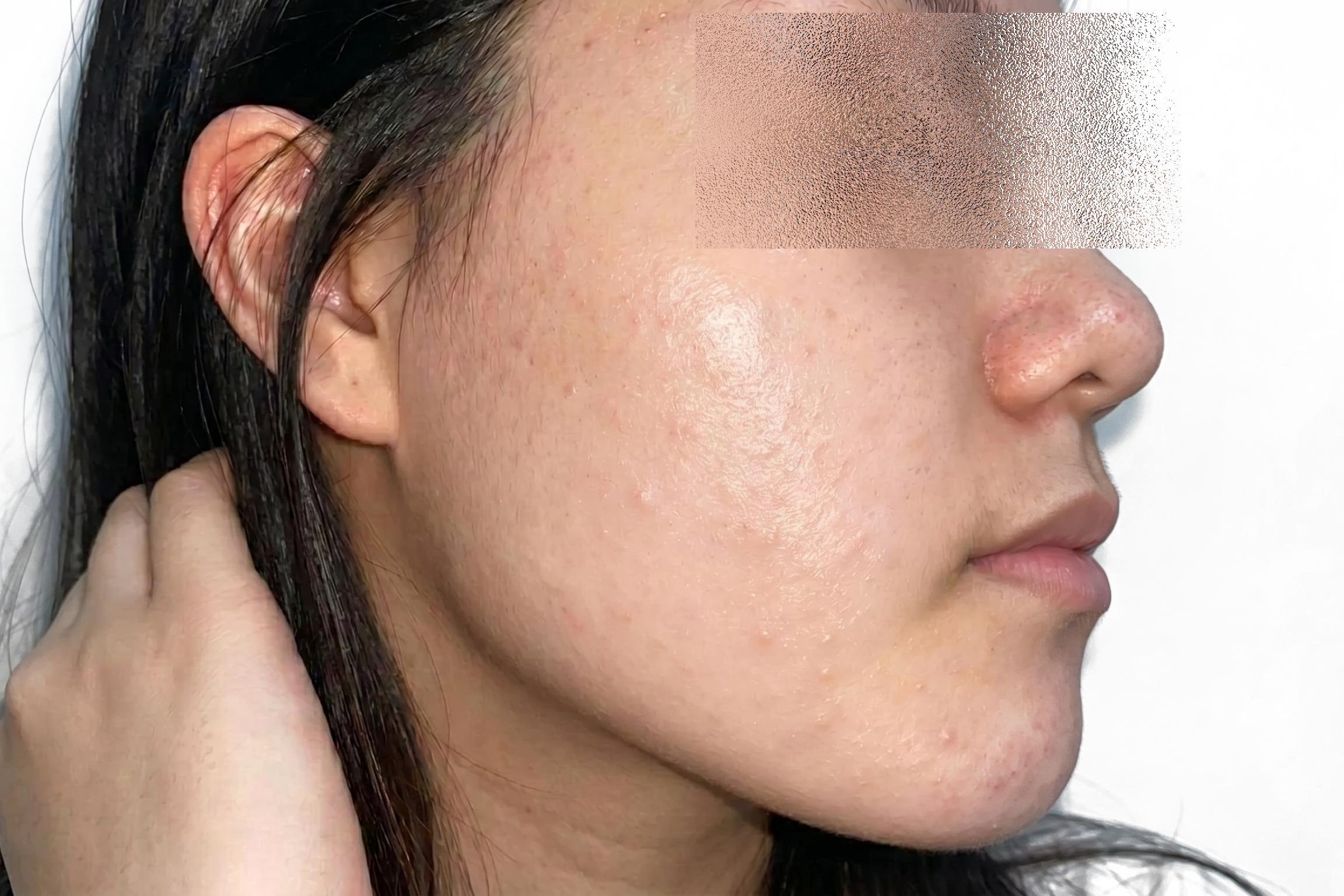 Case 2 Lumiderm Rx After