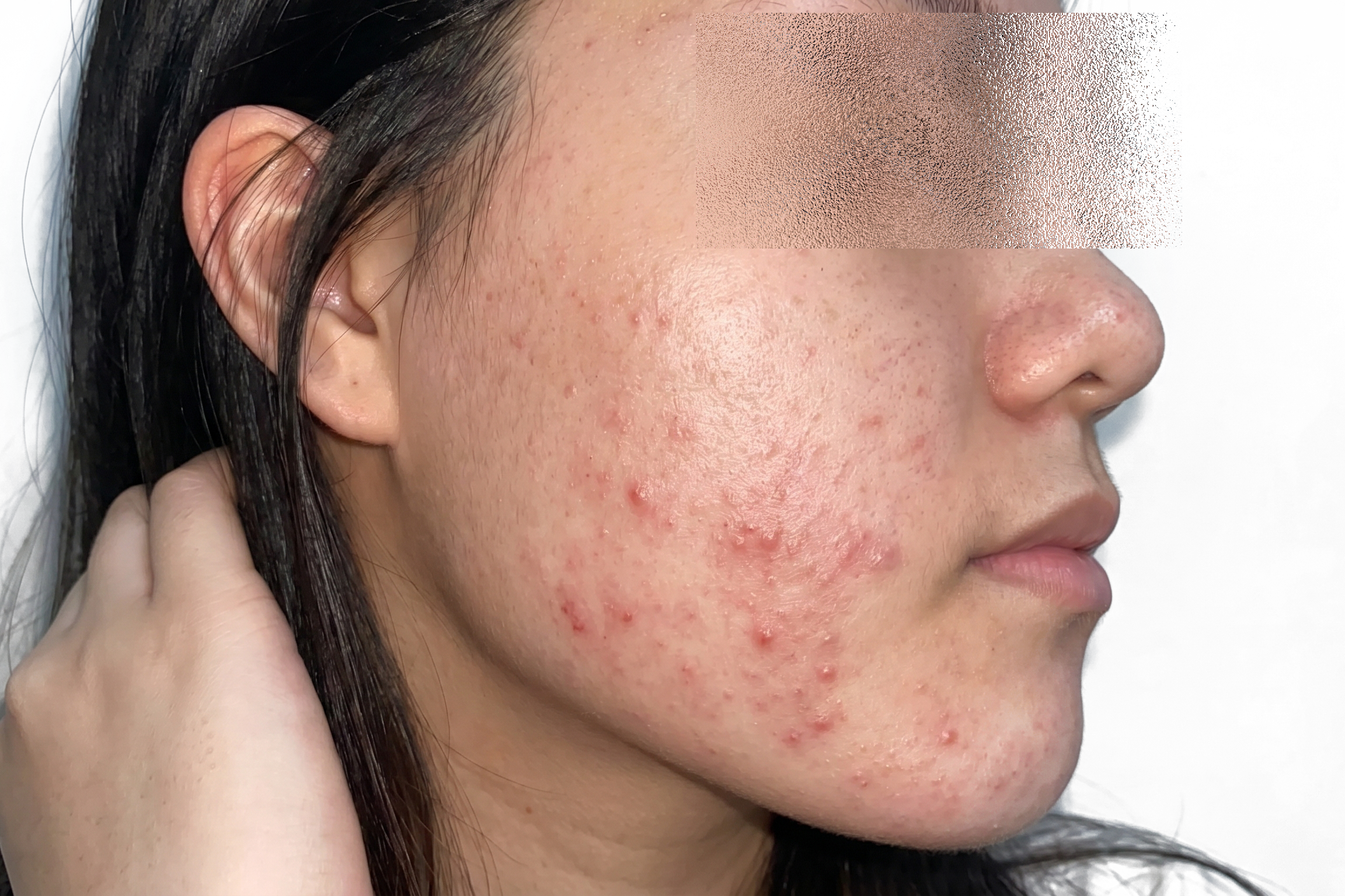 Case 2 Lumiderm Rx Before