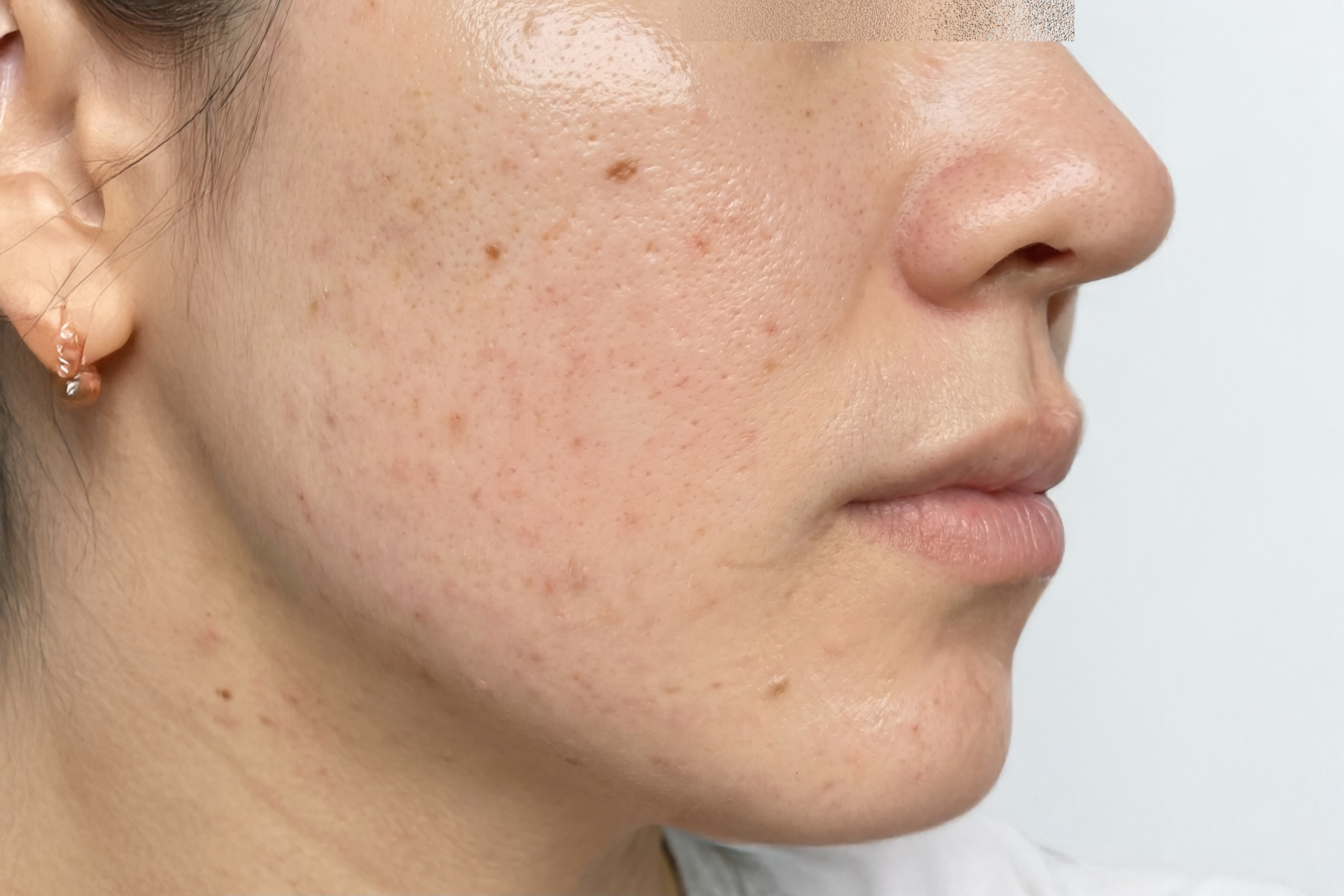 Case 3 Lumiderm Rx After scaled